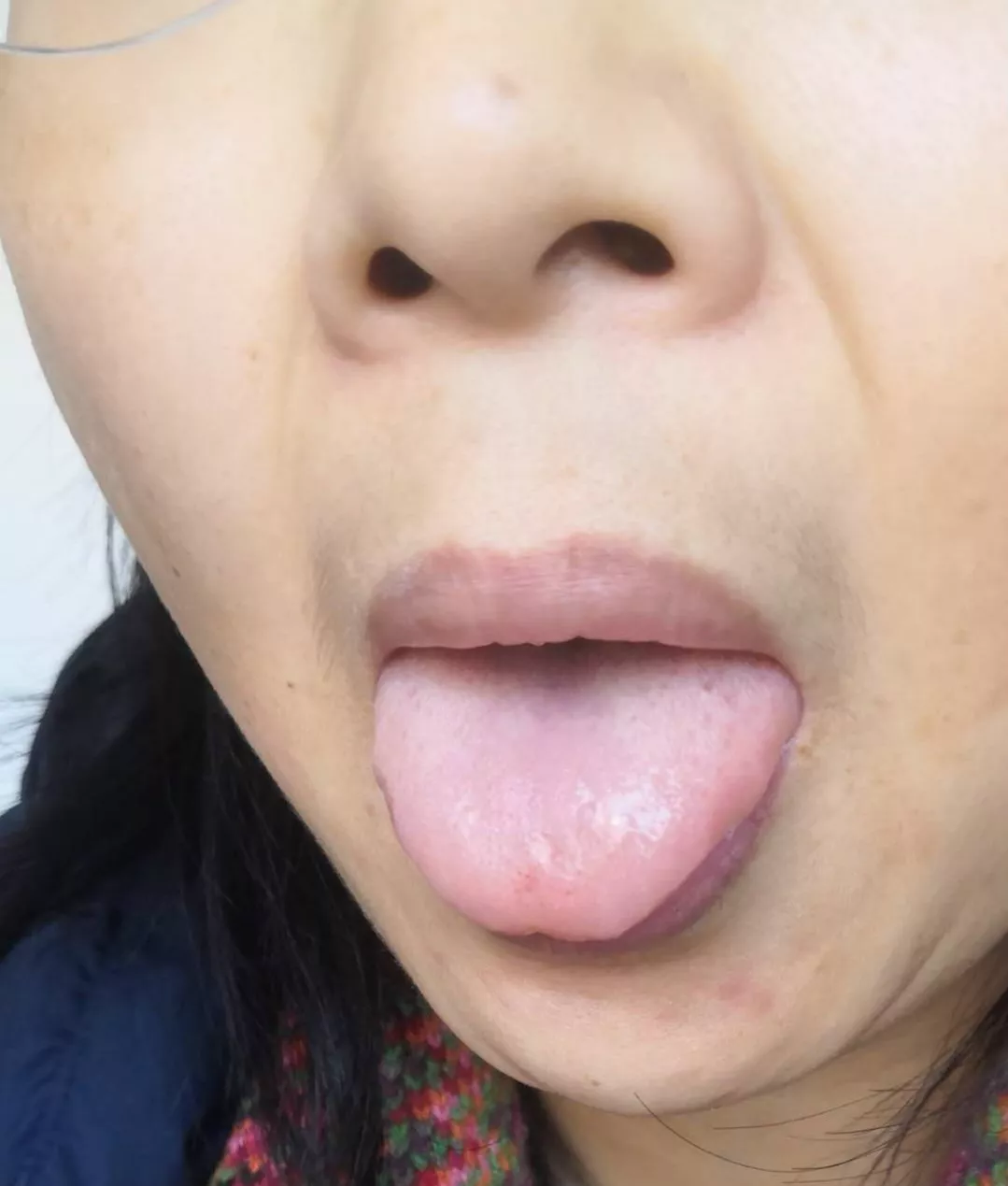 宋柏杉：以一例贫血案例探讨“治病求本”
