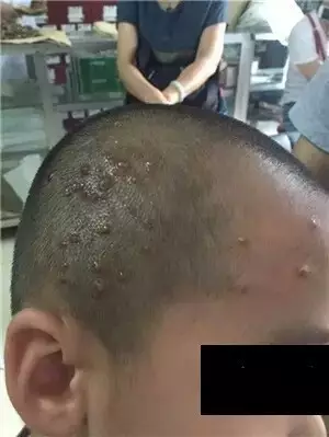 脓疱疮按感冒治？宋柏杉再谈中医治病一定要用中医思维