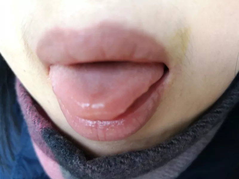 贫血案2.webp