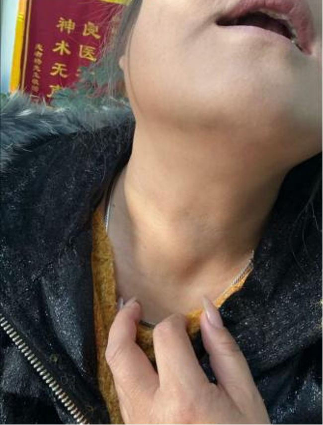 病例二治疗前.png