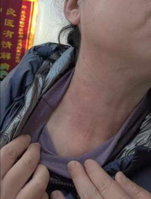 病例一治疗后.png