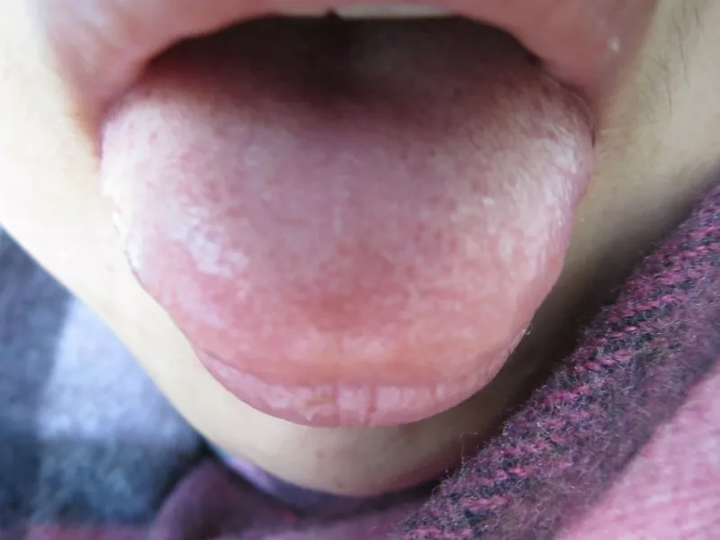 贫血3.webp