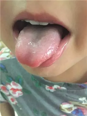 脓包疮A4.webp