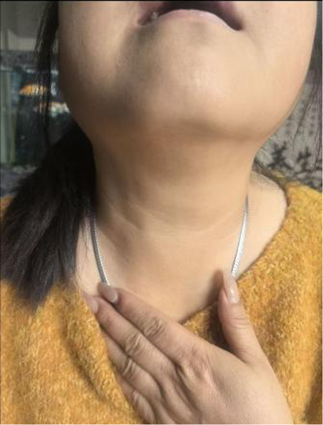 病例二治疗后.png